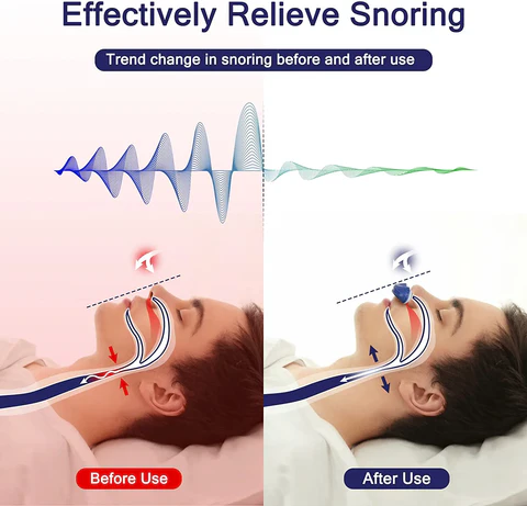 Micro CPAP Schlafapnoe-Maschine für Reisen & Anti-Schnarchen - CPAP-Alternative